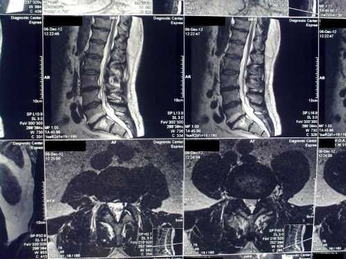 Лечение острых травм спинного мозга: переломов и вывихов