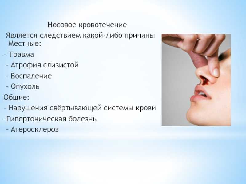 Носовое кровотечение – причины и лечение. носовые кровотечения у взрослых и детей.
