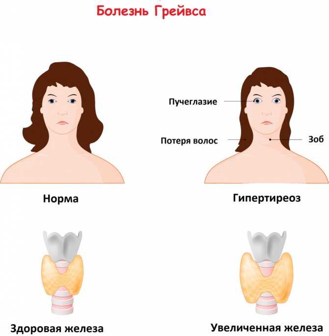 Гиперпаратиреоз. заболевание (пара)щитовидных желез.